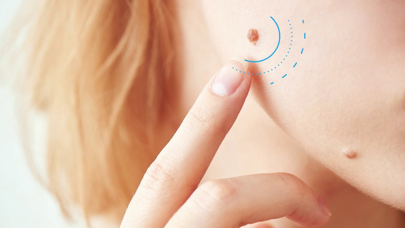 When should you get your moles checked?